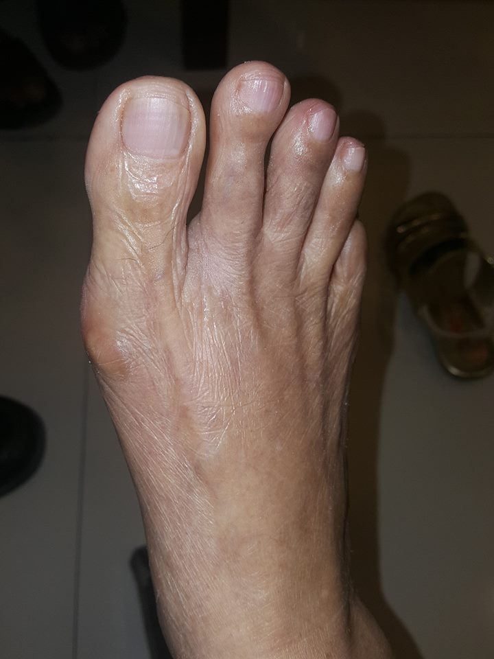 The bunion after using the splint